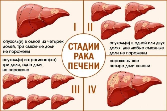Рак печени