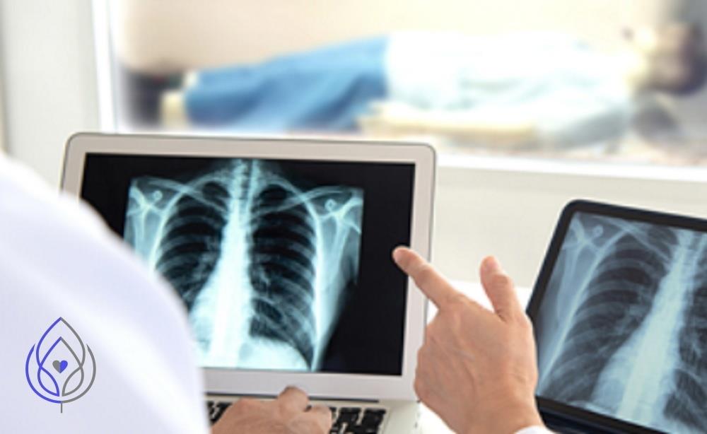 Рак лёгкого