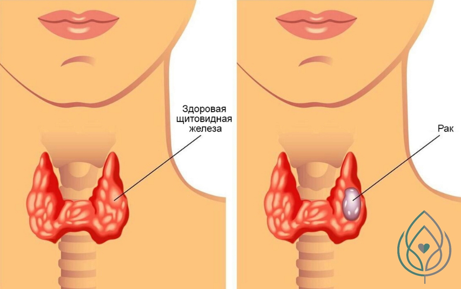 Презентация о щитовидной железе