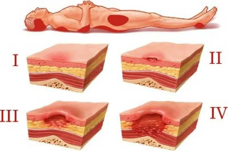 Пролежни представляют собой одну из самых серьезных проблем для пациентов, которые находятся в лежачем положении